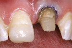 Figure 12  Ten weeks after crown lengthening, the crown preparation was completed and demonstrated the 2-mm ferrule necessary to support the final all-ceramic crown.
