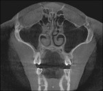 A coronal CBCT section shows a deviated nasal septum (to the right). Note the significant
narrowing of the right nasal chambers because of the deviated septum.