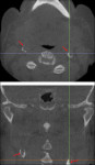 Axial (above) and coronal (below)
CBCT sections of the same patient depict
large ring-like calcifications on either side
of a vertebral body (most likely C3 and
laterally to the airway); their appearance is
consistent with carotid artery calcifications
due to atheromatosis. This is an example of
an incidental pathological entity that needs
to be addressed rather soon (informing the
patient’s physician for further investigation
and possible treatment).