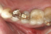 (12.) Extraction of fractured and decayed No. 12 with periapical granuloma and original