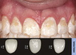 Figure 1  A 17-year-old boy presented with significant discoloration on all of his teeth, in particular the anterior teeth. Using the Chair Side Shade Selection Guide, the patient’s surface texture was checked as part of the custom shading process.