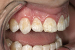 Figure 2  A 17-year-old boy presented with significant discoloration on all of his teeth, in particular the anterior teeth. Using the Chair Side Shade Selection Guide, the patient’s surface texture was checked as part of the custom shading process.
