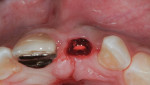 Fig 4. Bone replacement procedure (allogenic bone graft) placed into the pouch facial to preexisting deficient buccal plate.