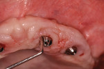 (4.) Excessive probing depth, anterior left implant.