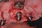 (10.) Implant surface appearance after mechanical and chemical detoxification, maxillary left quadrant.