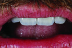Fig 19. Post-treatment view of central incisors.