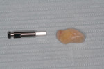 Fig 9. Abutment analog used for trimming of ETPC. Note natural contours of ETPC.