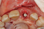 Fig 8. Prefabricated hexagonal abutment placed into implant.