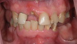 (1.) Pretreatment retracted view of the patient’s failing dentition.