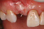 (9.) The connective tissue graft is pulled into position to create a natural prominence of the missing tooth’s root.