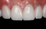 (16.) Result with lithium disilicate veneers placed on natural teeth and a lithium disilicate crown placed on the implant abutment.