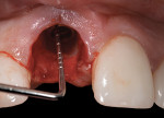Fig 7. The implant was placed in a palatal position 3 mm from the free gingival margin.