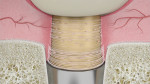 Fig 6. Abutment surrounded
by circular fibers, a key factor in tissue stability.