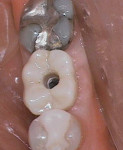 Ideally-placed implant creating a centric screw access and well-supported ceramics for long-term durability.