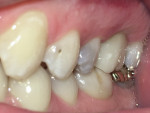 Immediate postoperative buccal view of delivered restoration.