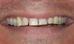 Figure 2  The patient had little time to invest in treatment and little desire to extend treatment beyond a short time commitment (his wedding date). He wanted to know how little drilling could be done with the greatest impact on his smile. He was hi