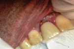 Clinical presentation of patient. There is moderate gingival recession from the crown margin, and a small fistula visible on the marginal gingiva.