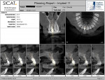Planning report shows the radiographic condition of the failing tooth No. 8 as well as the treatment plan. It can be seen that with the implant planned in the ideal position for a cement-retained final prosthesis, there is adequate bone surrounding the fixture for good initial primary stability and ridge maintenance.