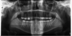 Fig 3. DBI seen on the mandibular left first premolar.