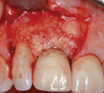 From both the palatal and facial aspects, the rhPDGF-BB enriched bone allograft is placed into the defect, intentionally overbuilding about 20% to compensate for consolidation after surgery.