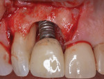 Flap access is followed by mechanical and chemical treatment of the contaminated
implant surface and mesial root surface of tooth No. 7.