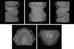 Fig 18. Post-treatment dental casts.