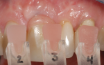 Fig 6. Gingiva shade was taken with custom-fabricated pink porcelain tabs.