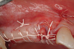 Fig 6. Buccal and palatal flaps sutured.