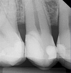 Fig 14. Radiograph taken 14 months later showing apparent formation of reparative dentin. The tooth was asymptomatic and pulp-tested vital.