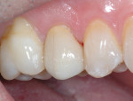 Fig 15. Finished restoration tooth No. 4 (lithium-disilicate crown) placed approximately 22 months after the direct pulp capping procedure.