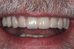 Fig 4. Low smile line hides the transition line between the patient’s gingiva and the gingiva-colored acrylic of the provisional implant-supported prosthesis, which represents a favorable scenario.