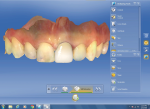 The software’s “Biogeneric Reference” feature was used to design the restoration using the shape, size, and form of tooth No. 8.