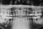 Fig 8. This 34-year-old woman presented with generalized aggressive periodontitis. She had experienced rapid attachment loss with up to
50% loss of alveolar bone as evidenced by this panoramic radiograph.