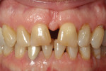 Patient’s initial presentation with fractured central incisors.
