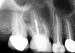 Endodontic re-treatment, new post, and lithium disilicate crown. Note the marginal adaptations.