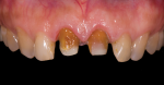 Fig 3. Teeth undergo preparation.