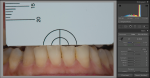 Fig 4. A photograph of teeth Nos. 22 through 27 is taken according to eLAB protocol.