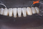 Thoroughly cleaned and pristine teeth, ready
for etching.