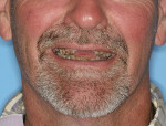Severely worn teeth have devastated this patient’s ability to chew and smile.