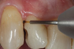 Super-pulsed diode laser used to create a supragingival margin to allow for easier matrix placement and a better seal during flowable composite placement.