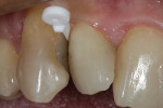 WedgeGuard placed to protect the adjacent proximal surface during removal of the existing composite.