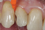 A matrix is placed and wedged to seal the gingival margin of the preparation.