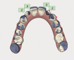 Fig 16. Occlusal view showing an overlay of the pre- and postorthodontic software models, with the purple areas representing the tooth position in the preoperative model.