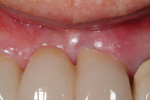 Fig 1. Gingival swelling on labial aspect of fixed bridge abutment maxillary left central incisor.
