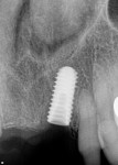 Fig 3. Radiograph showing 5-mm x 11.5-mm dental implant placed immediately after extraction of left central incisor tooth.