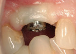 Figure 18 Placement of 4-mm tall CAD/CAM healing abutment to facilitate final impression.