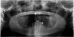 Fig 2. Pre-operative x-ray shows the failed implants.