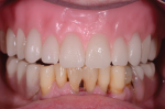 Fig 6. Wax-based tooth try-in is used.