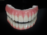 Fig 12. High-water PMMA milled sleep denture offers friction fit only, with no caps.