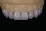 Fig 12. Another case using extra-white GC Initial LiSi Press.